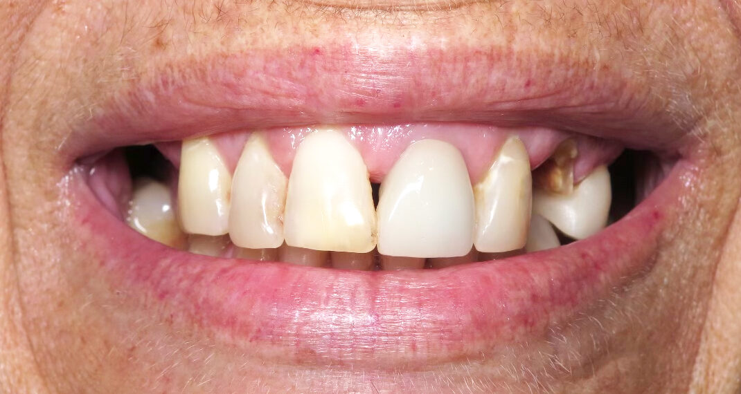 Before photo | West Wind Dental