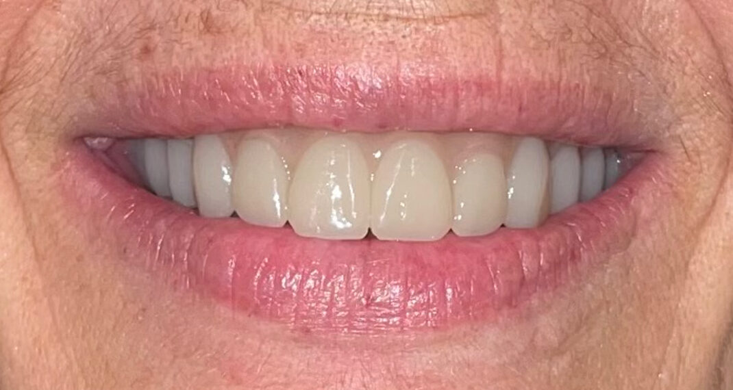 After Photo | West Wind Dental