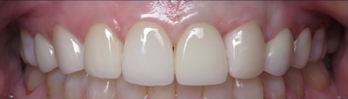 After Veneers | West Wind Dental